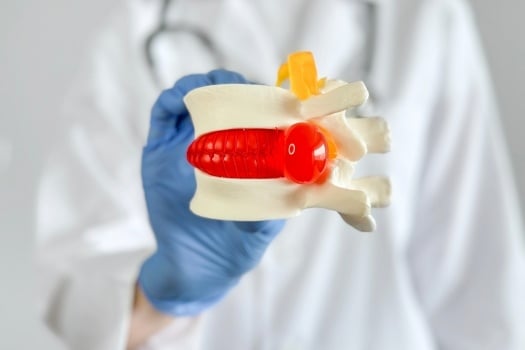 12.23 - What Are the Final Stages of a Herniated Disc