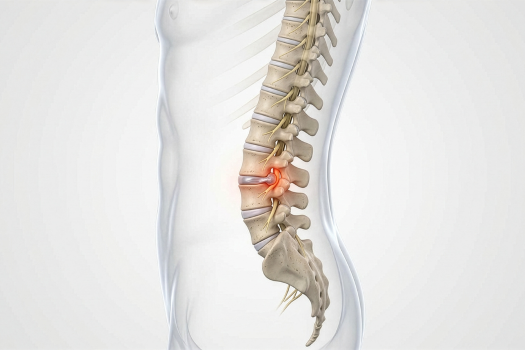 6.8 - Long-Term Outcomes of Lumbar Discectomy_ Analyzing Success Rates and Recovery Timelines Barricaid USA