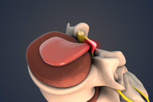 8.23 - Can You Have a Herniated Disc on Both Sides