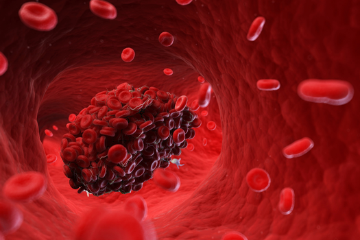 9.10 - How to Prevent Blood Clots after Lower Back Surgery
