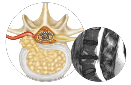 Lumbar Herniated Disc_Barricaid