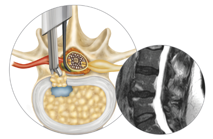 Lumbar discectomy surgery_Barricaid