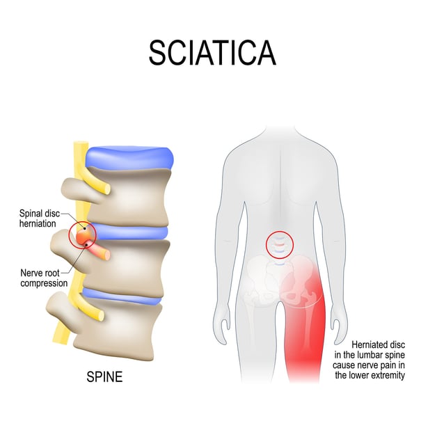 Pain on the Outer Side of Your Foot: Could It Signal a Spine Problem?