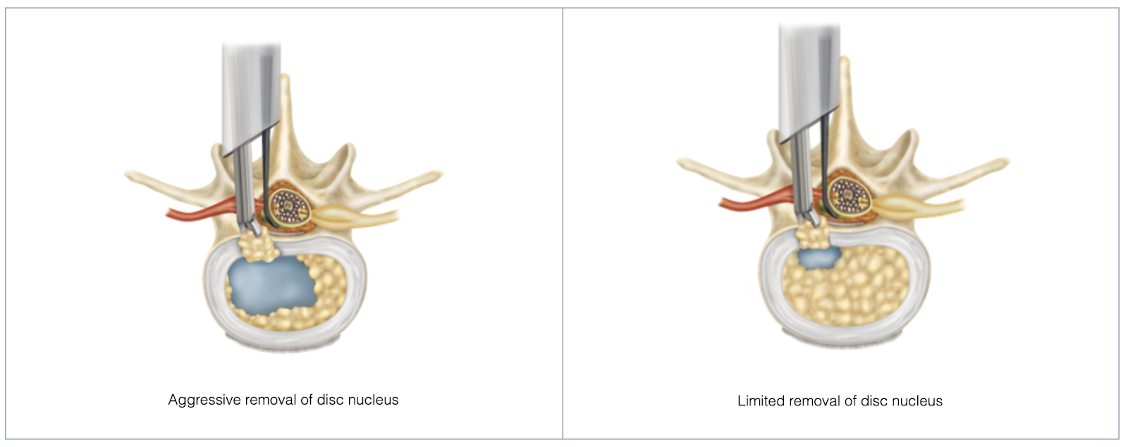 Understanding the Types of Discectomy Surgery