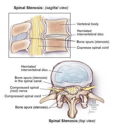 Herniated Disc vs. Spinal Stenosis: How Do They Differ?