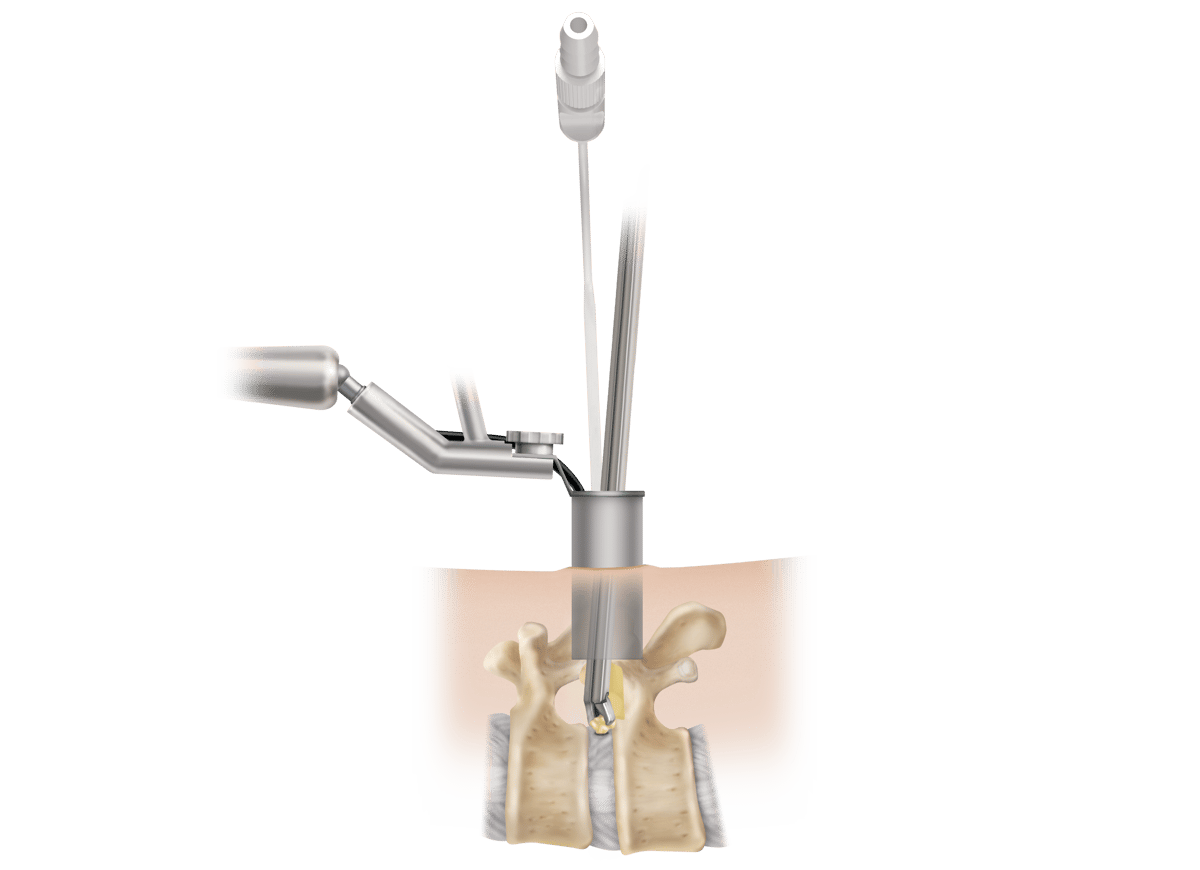 Different Approaches to Lumbar Discectomy Surgery