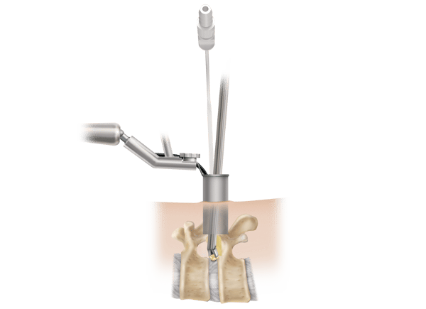 Tubular-discectomy-illustration-edit-ML