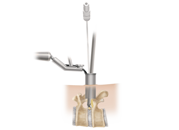 Tubular-discectomy-illustration-edit-ML