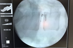 fluoroscopic image of implant in position