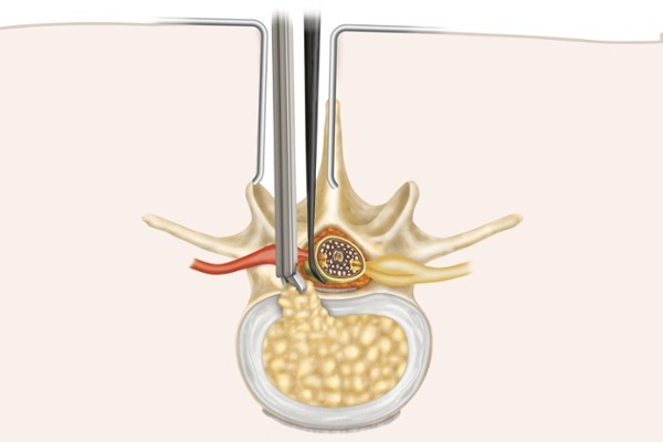 open lumbar discectomy illustration