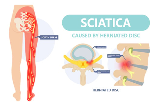 Is Experiencing Sciatic Pain After Microdiscectomy Surgery Normal?