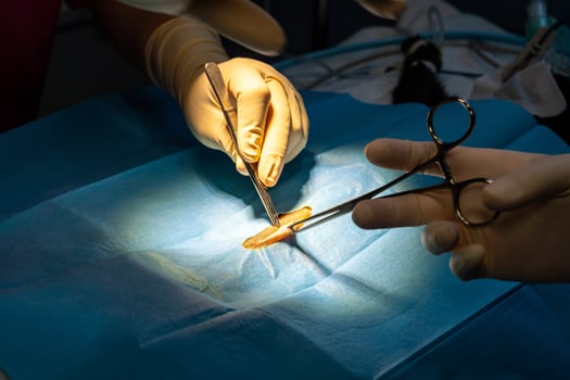 Caring for an Incision After Microdiscectomy Surgery