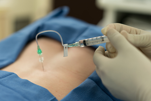 How Long Do Epidural Injections Alleviate Herniated Disc Pain?
