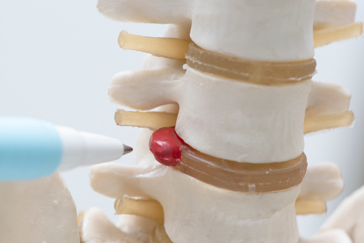 Can You Treat Herniated Discs Yourself?
