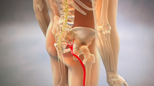 Can You Cure Sciatica Permanently?