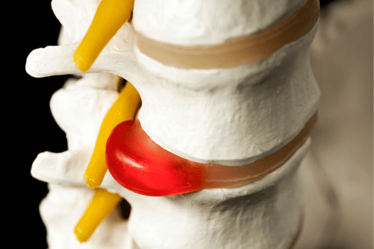 Can You Push a Herniated Disc Back into Place?