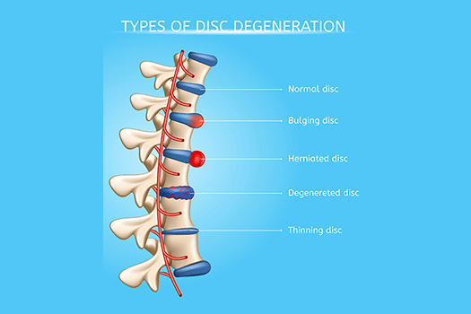 Herniated Disc: Symptoms, Causes, Diagnosis & Treatments - Mater