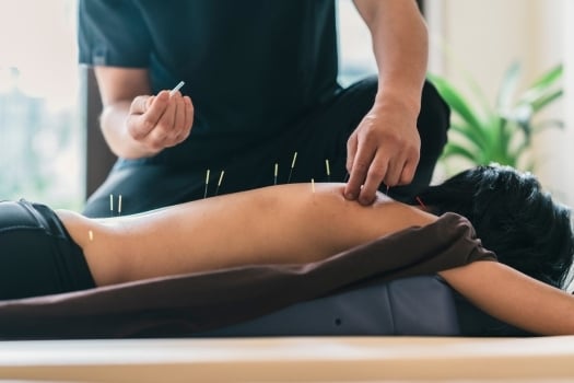 Will Acupuncture Work on Sciatica?