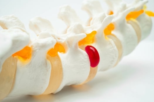What Is a Herniation of the Spine?