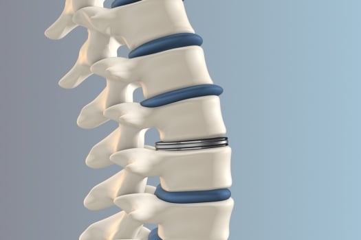 What Replaces the Disc after a Discectomy?