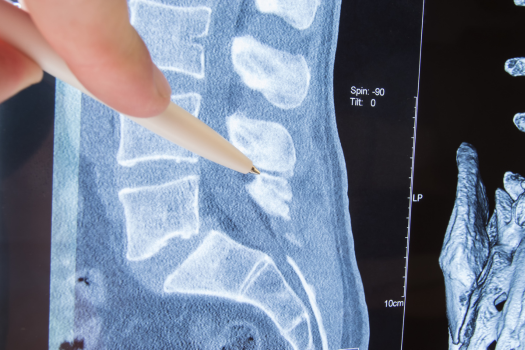 Does Microdiscectomy Help with Spinal Stenosis?