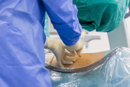 Can You Get an Epidural after a Discectomy?