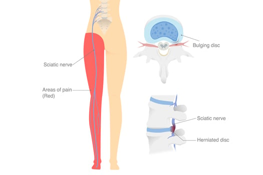 9 Secrets to Get Sciatic Nerve to Stop Hurting