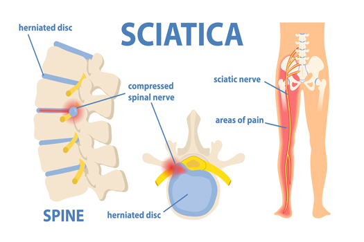 4 Common Types of Sciatica